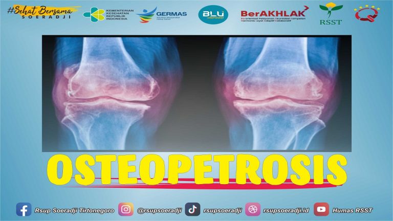 kesehatan-osteopetrosis-gejala-penyebab-dan-penanganannya