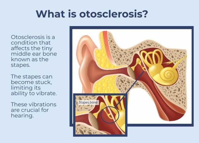 kesehatan-otosklerosis-penyebab-gejala-dan-penanganannya