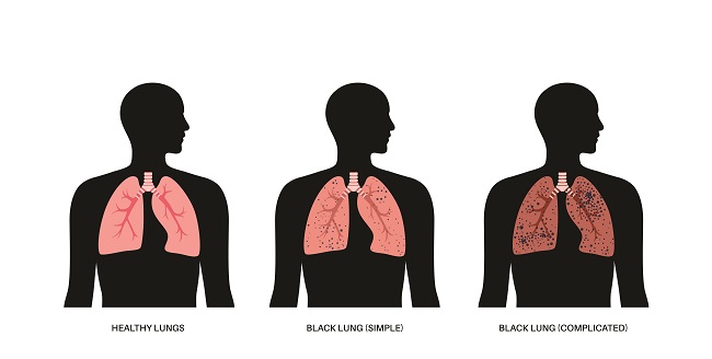 kesehatan-penderita-penyakit-black-lung-gejala-dan-pencegahan