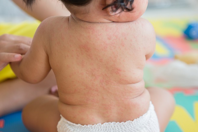 kesehatan-roseola-gejala-penyebab-dan-cara-penanganan-yang-tepat