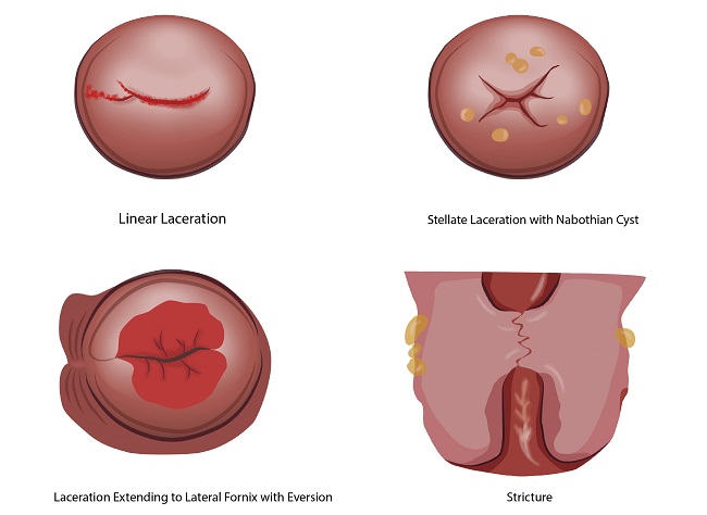 kesehatan-ruptur-perineum-penyebab-gejala-dan-penanganan
