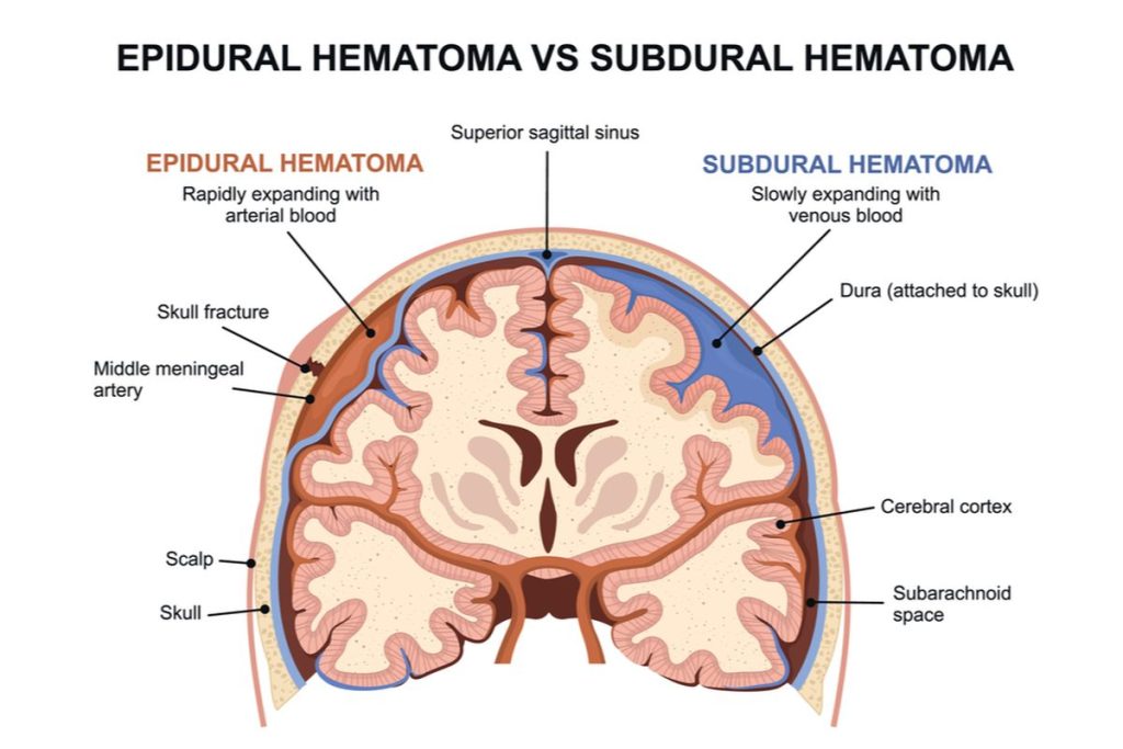 kesehatan-subdural-hematoma-gejala-penyebab-dan-pengobatan