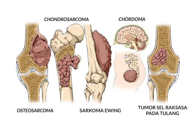 kesehatan-tumor-tulang-gejala-penyebab-dan-pengobatan-yang-perlu-diketahui
