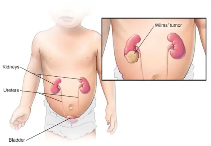 kesehatan-tumor-wilms-gejala-penyebab-dan-pengobatannya
