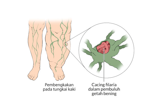 memahami-gejala-dan-penanganan-kesehatan-kaki-gajah