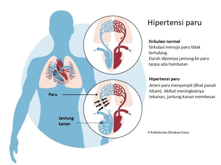 memahami-kesehatan-dan-pengelolaan-hipertensi-pulmonal
