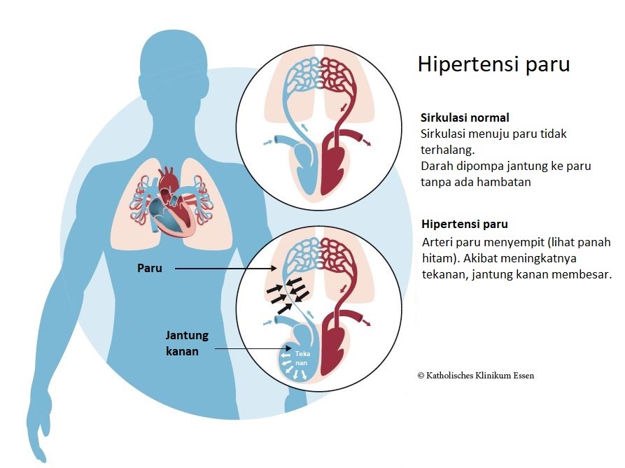 memahami-kesehatan-dan-pengelolaan-hipertensi-pulmonal