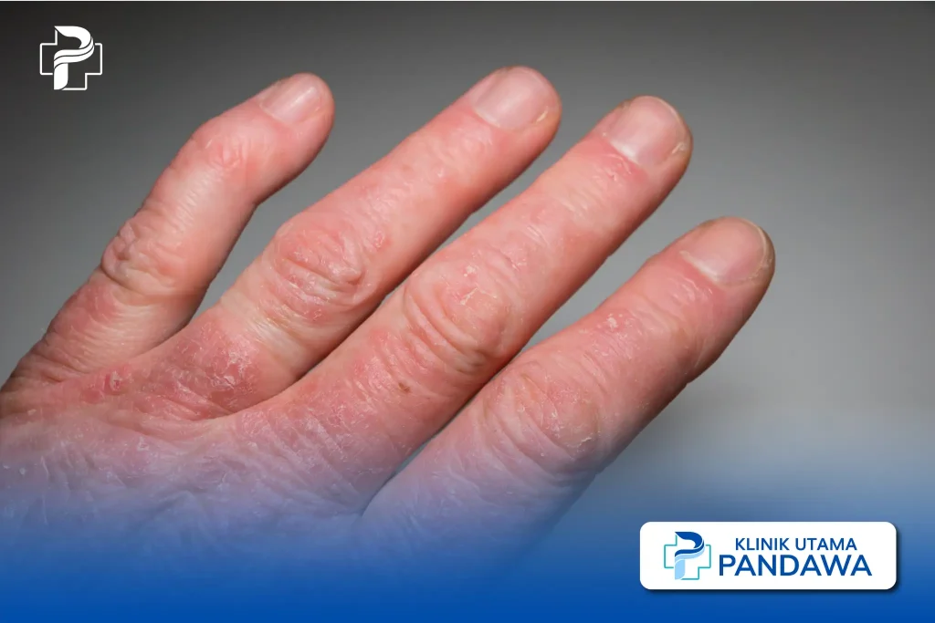 memahami-kesehatan-dan-pengelolaan-psoriasis-arthritis