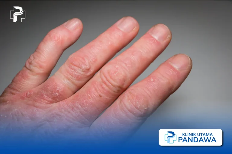 memahami-kesehatan-dan-pengelolaan-psoriasis-arthritis