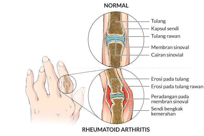 memahami-kesehatan-dan-pengelolaan-rheumatoid-arthritis