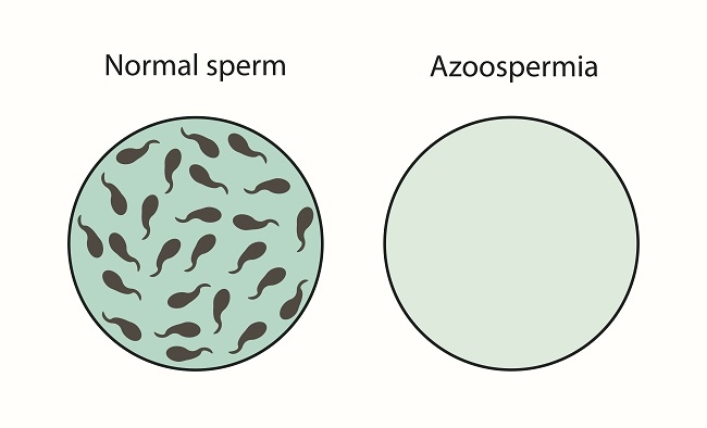 memahami-kesehatan-dan-pengobatan-azoospermia-pada-pria