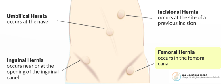 memahami-kesehatan-hernia-femoralis-gejala-dan-pengobatannya