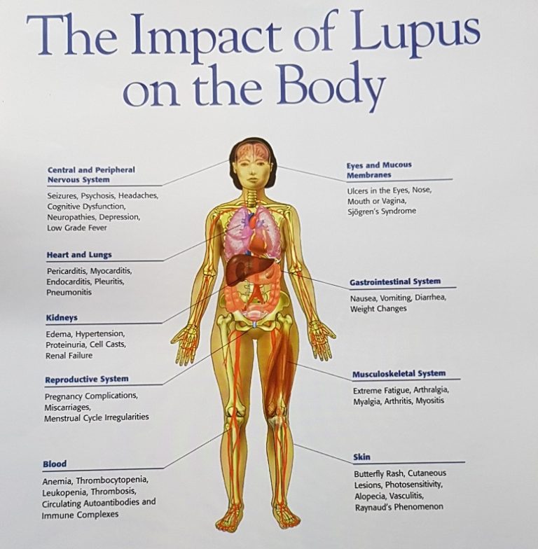 memahami-kesehatan-lupus-nefritis-gejala-dan-penanganannya