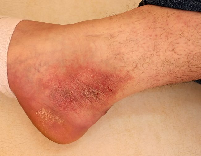 memahami-kesehatan-neurodermatitis-penyebab-dan-penanganan-efektif