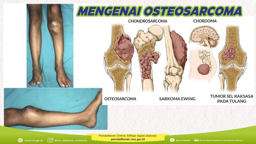 memahami-kesehatan-osteosarcoma-gejala-penyebab-dan-pengobatan
