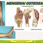 memahami-kesehatan-osteosarcoma-gejala-penyebab-dan-pengobatan