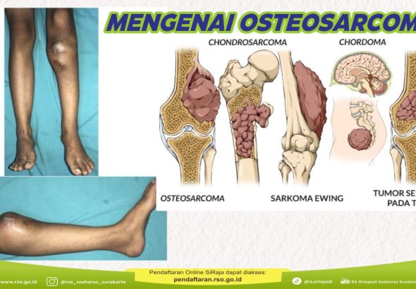 memahami-kesehatan-osteosarcoma-gejala-penyebab-dan-pengobatan