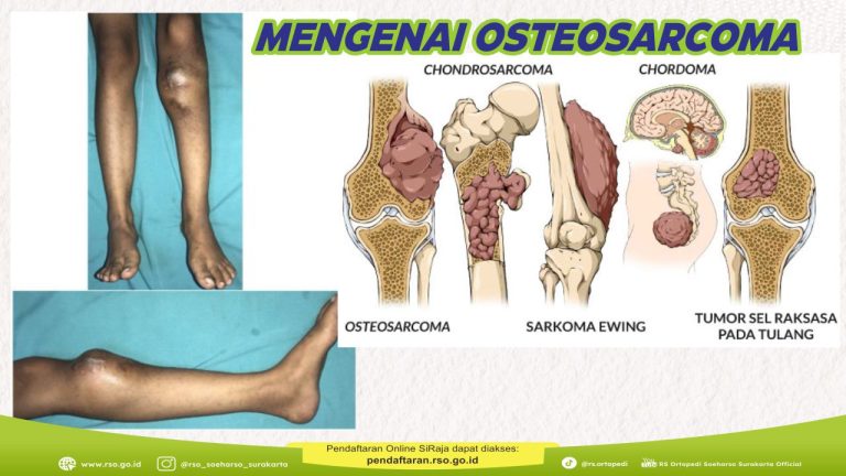 memahami-kesehatan-osteosarcoma-gejala-penyebab-dan-pengobatan