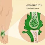 mengenal-osteomielitis-penyakit-tulang-yang-perlu-diketahui
