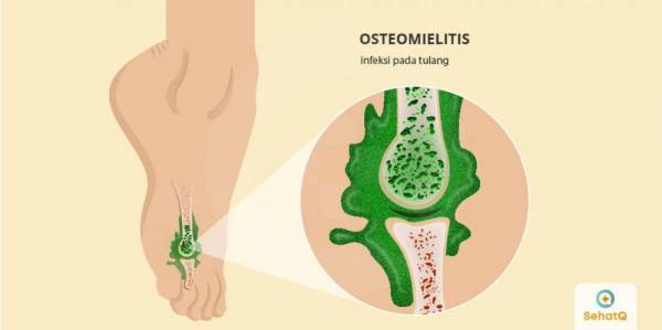 mengenal-osteomielitis-penyakit-tulang-yang-perlu-diketahui