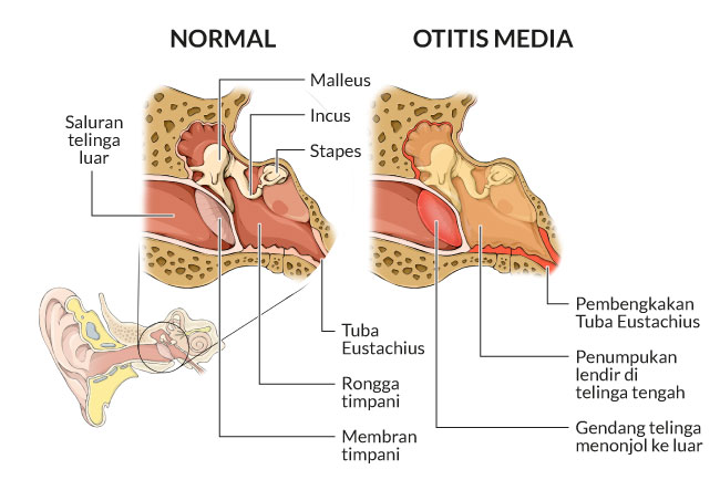 panduan-lengkap-tentang-kesehatan-otitis-media-dan-penanganannya