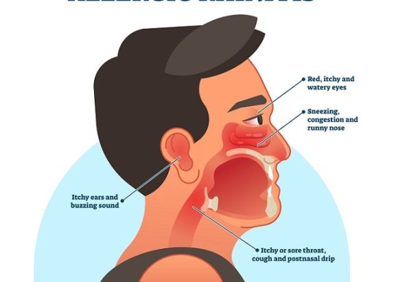 panduan-lengkap-tentang-kesehatan-rhinitis-alergi-dan-penanganannya