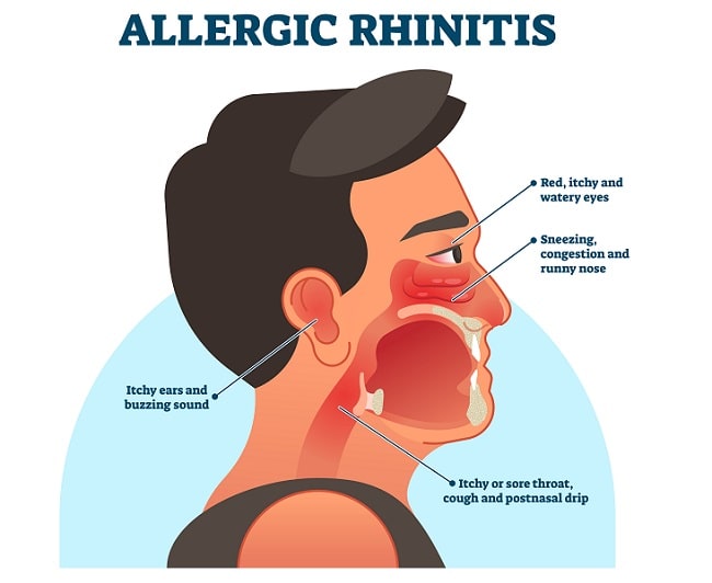 panduan-lengkap-tentang-kesehatan-rhinitis-alergi-dan-penanganannya