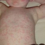 panduan-lengkap-tentang-kesehatan-roseola-pada-anak