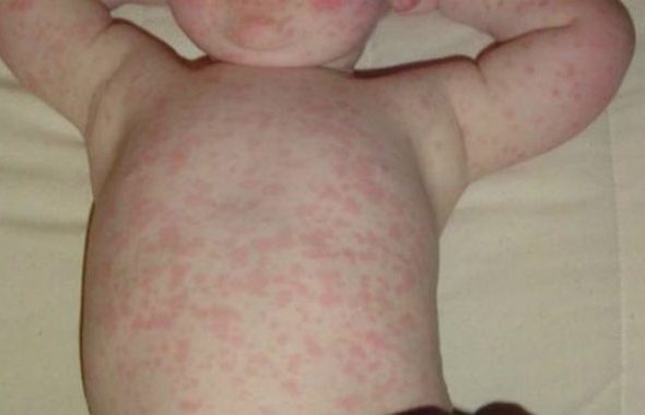 panduan-lengkap-tentang-kesehatan-roseola-pada-anak