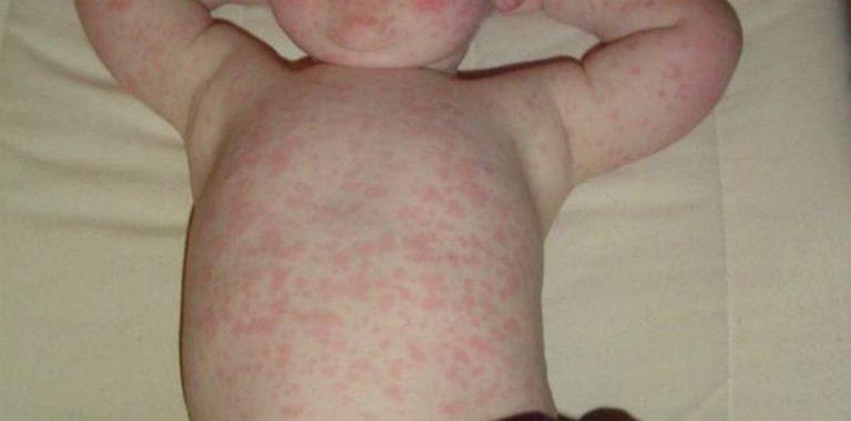 panduan-lengkap-tentang-kesehatan-roseola-pada-anak