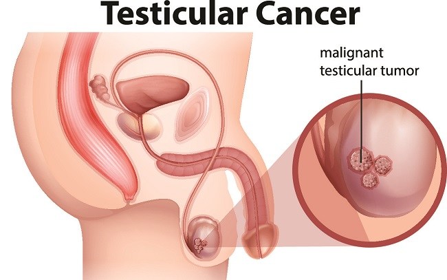 panduan-lengkap-tentang-kesehatan-tumor-testis-dan-pencegahannya