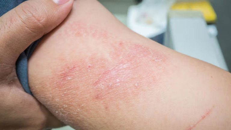 pemahaman-dan-penanganan-dermatitis-untuk-kesehatan-kulit-optimal