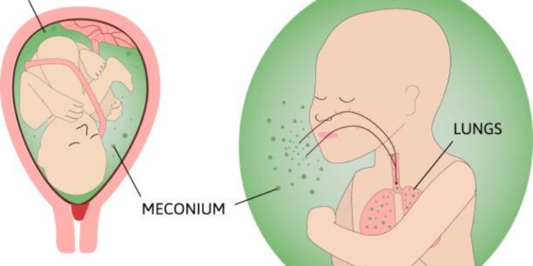 pemahaman-kesehatan-aspirasi-mekonium-pada-bayi-baru-lahir