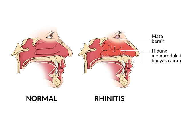 pemahaman-kesehatan-dan-penanganan-rhinitis-alergi