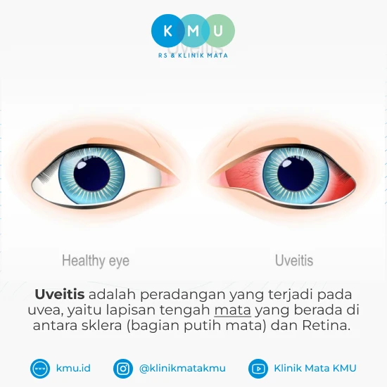 pemahaman-kesehatan-dan-penanganan-uveitis-mata