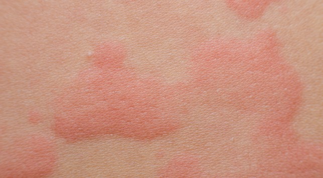 pemahaman-kesehatan-tentang-dermatitis-numularis-dan-penanganannya