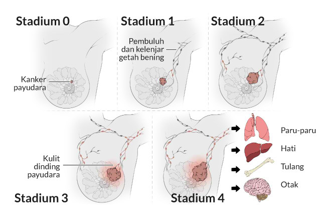pemahaman-tentang-kesehatan-tumor-payudara-dan-pencegahannya