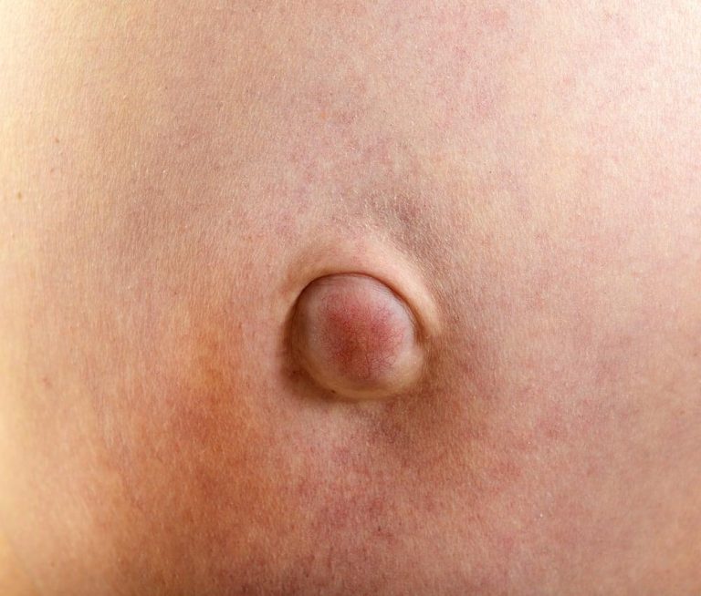 pengenalan-dan-penanganan-hernia-umbilikalis-pada-anak-dan-dewasa