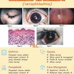 pengertian-dan-upaya-pencegahan-xerophthalmia-dalam-kesehatan-mata