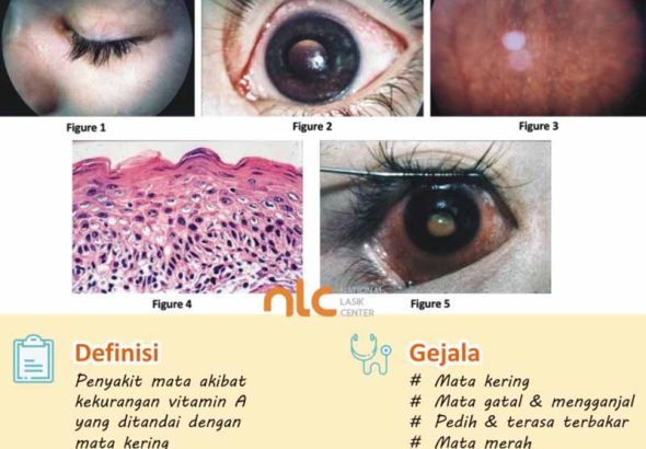 pengertian-dan-upaya-pencegahan-xerophthalmia-dalam-kesehatan-mata