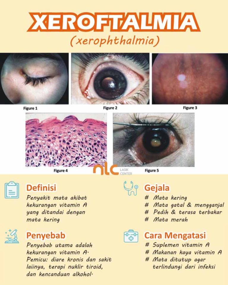 pengertian-dan-upaya-pencegahan-xerophthalmia-dalam-kesehatan-mata