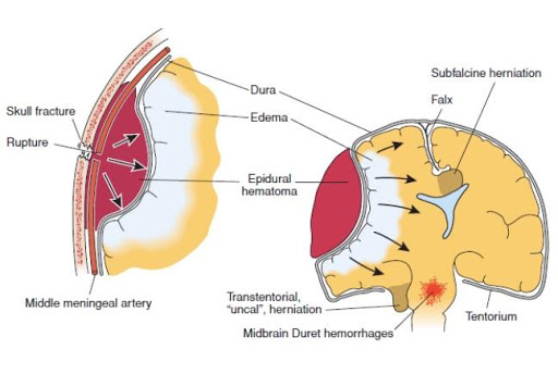 kesehatan-dan-penanganan-epidural-hematoma-secara-lengkap