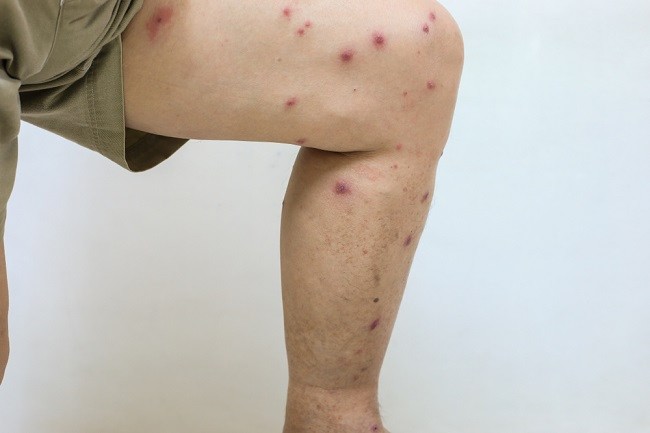 kesehatan-dan-penanganan-leishmaniasis-di-indonesia