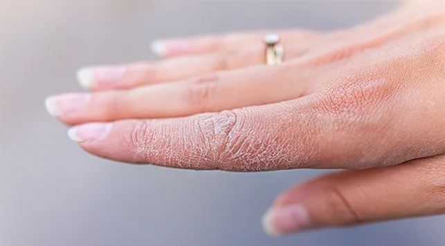 kesehatan-epidermolisis-bulosa-pemahaman-dan-perawatan-yang-diperlukan
