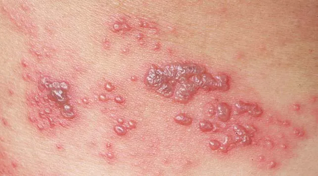 kesehatan-impetigo-penyebab-gejala-dan-pengobatan-yang-perlu-diketahui