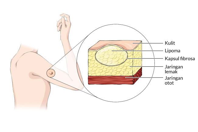 kesehatan-lipoma-penyebab-gejala-dan-penanganan-yang-perlu-diketahui