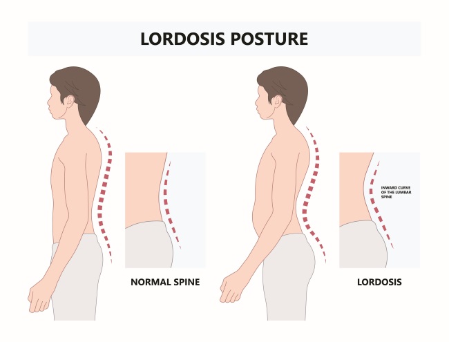 kesehatan-lordosis-penyebab-gejala-dan-cara-menjaga-keseimbangan