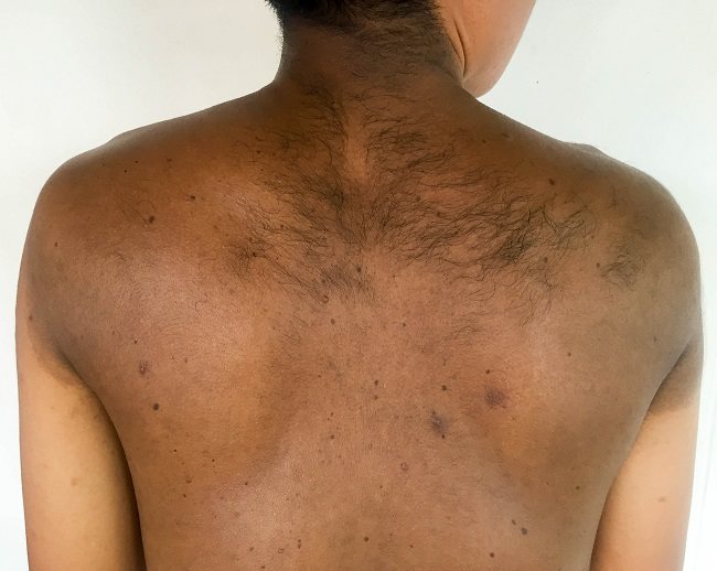 kesehatan-neurofibromatosis-tipe-1-gejala-penyebab-dan-penanganan