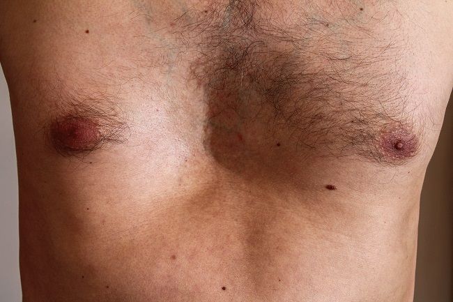 kesehatan-pectus-excavatum-gejala-penyebab-dan-penanganan