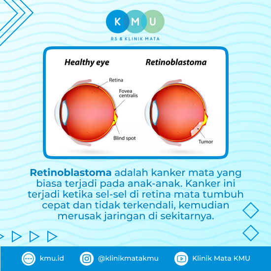 kesehatan-retinoblastoma-pemahaman-gejala-dan-penanganan